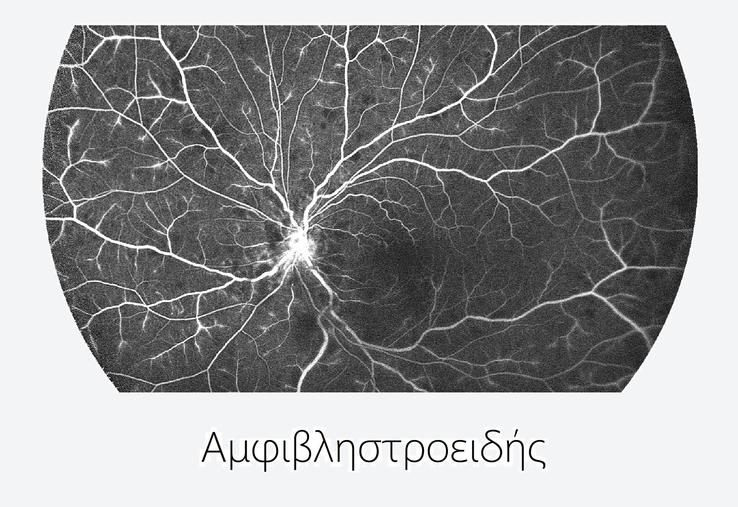 Widefield FFA Retina - Venous Vasculitis - CRVO